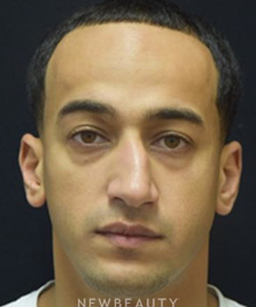 dr-jeffrey-b-wise-rhinoplasty-b