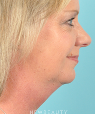 dr-bradley-bengtson-kybella-b