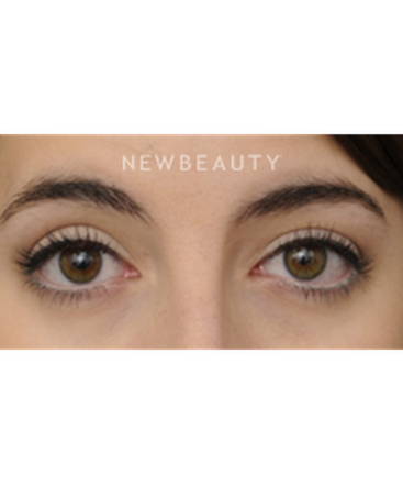 dr-raymond-douglas-upper-blepharoplasty-b