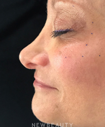 dr-jeffrey-wise-nonsurgical-rhinoplasty-b