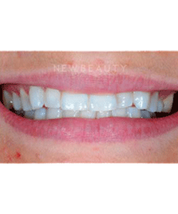 dr-guy-lewis-veneers-b