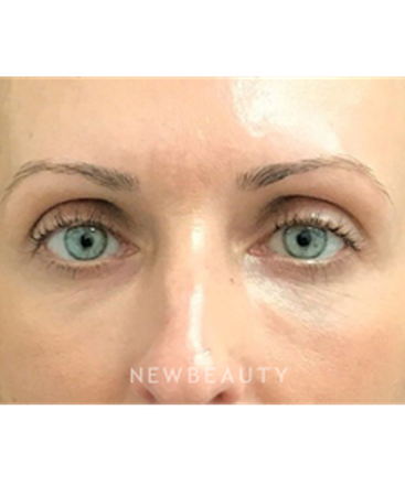 dr-janet-allenby-injectables-fillers-b