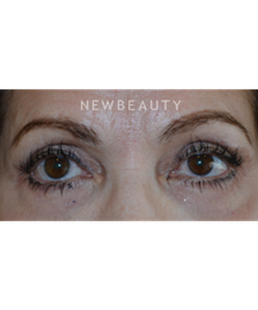 dr-baljeet-k-purewal-upper-blepharoplasty-b