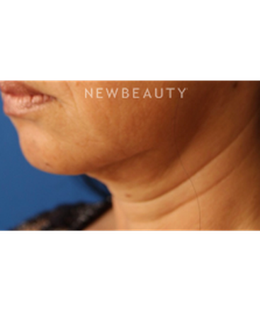 dr-jennifer-levine-botox-b