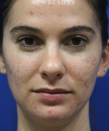 dr-jennifer-levine-lasers-b
