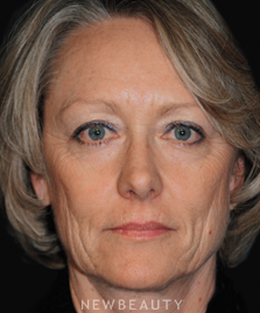 dr-brent-smith-blepharoplasty-facelift-lasers-b