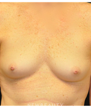 dr-andrew-smith-breast-augmentation-b