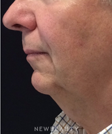 dr-kim-nichols-kybella-b