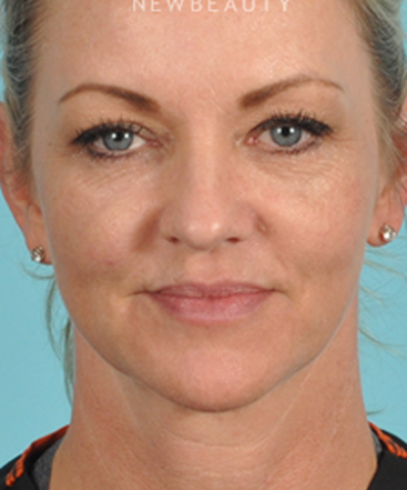 dr-bradley-bengtson-injectables-fillers-b