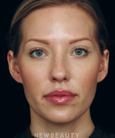 dr-jennifer-segal-browlift-cheek-augmentation-lip-enhancement-non-surgical-rhinoplasty-b