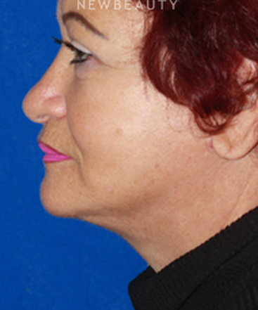 dr-konstantin-vasyukevich-lower-facelift-b
