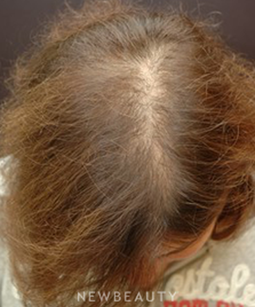 dr-jeffrey-b-wise-hair-transplant-b