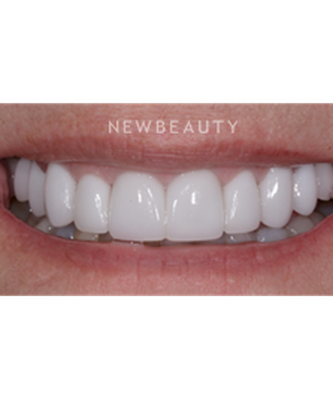 dr-guy-lewis-veneers-b
