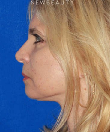 dr-konstantin-vasyukevich-upper-and-lower-blepharoplasties-b
