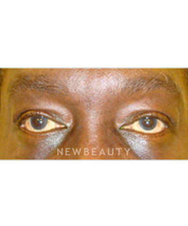 dr-baljeet-purewal-lower-blepharoplasty-b