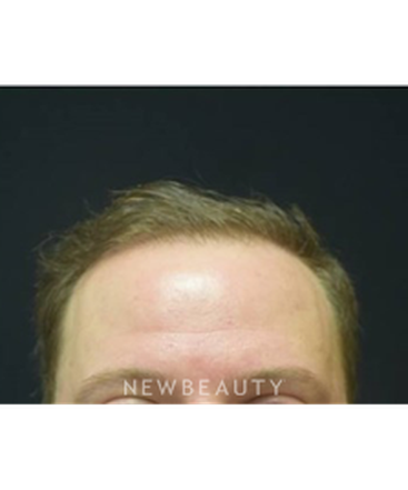 dr-jeffrey-b-wise-hair-transplant-b