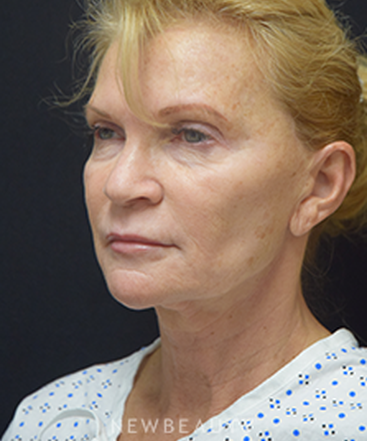 dr-jeffrey-b-wise-facelift-b