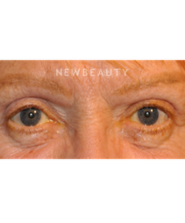 dr-baljeet-k-purewal-blepharoplasty-b