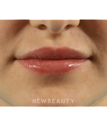 dr-marina-peredo-lip-augmentation-b