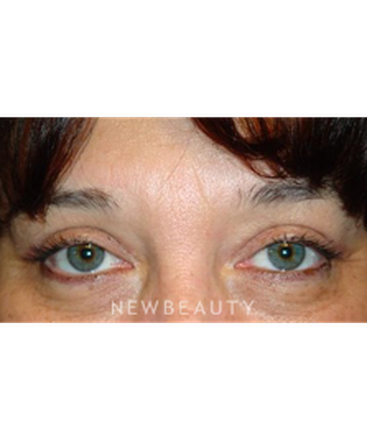 dr-baljeet-purewal-upper-blepharoplasty-b