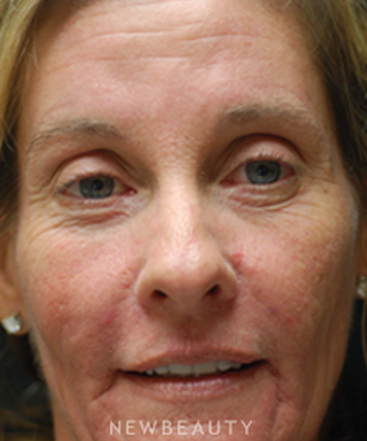 dr-kenneth-beer-injectables-fillers-ipl-lasers-b