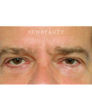 dr-raymond-douglas-lower-blepharoplasty-b