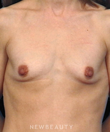dr-bradley-bengtson-shaping-the-breast-b