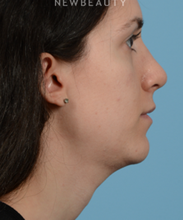 dr-jeffrey-wise-rhinoplasty-b