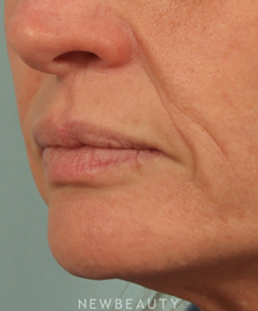 dr-kenneth-beer-injectables-fillers-juvederm-b