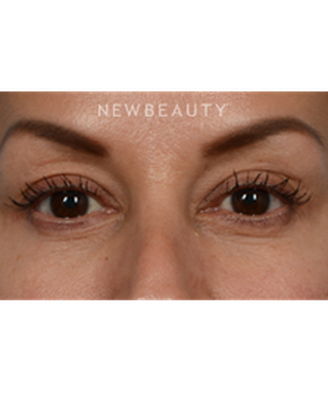 dr-jeffrey-wise-lower-blepharoplasty-b