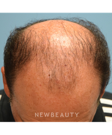 dr-jeffrey-wise-hair-loss-treatment-b