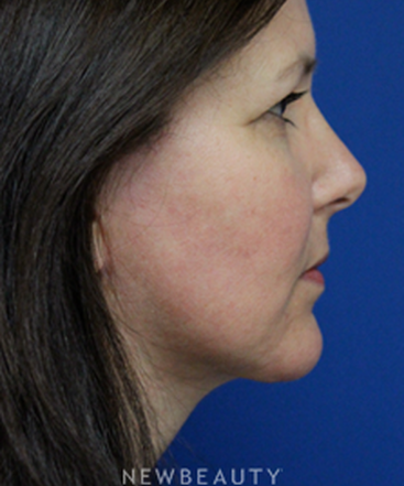 dr-joseph-russo-a-balanced-facial-profile-b