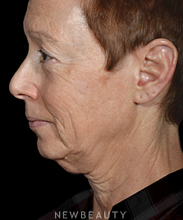 dr-ryan-p-chastant-rejuvenating-results-b