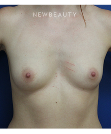 dr-joseph-russo-volume-boost-breast-ebg-b