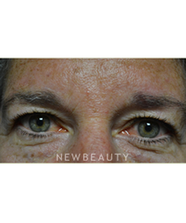 dr-baljeet-purewal-blepharoplasty-b