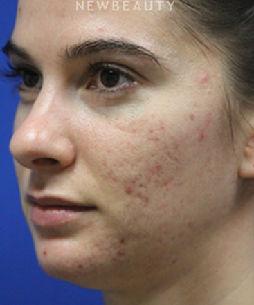 dr-jennifer-levine-lasers-b