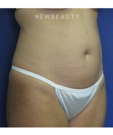 dr-joseph-russo-liposuction-of-the-abdomen-b
