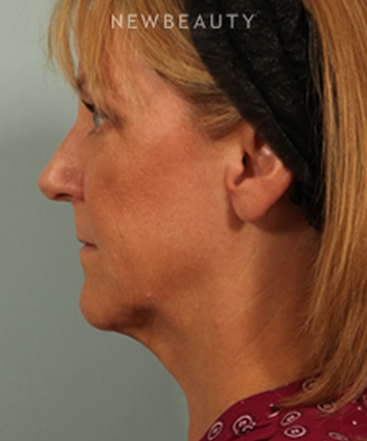 dr-kenneth-beer-kybella-b