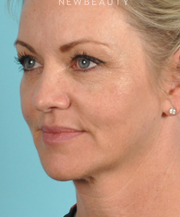 dr-bradley-bengtson-injectables-fillers-b