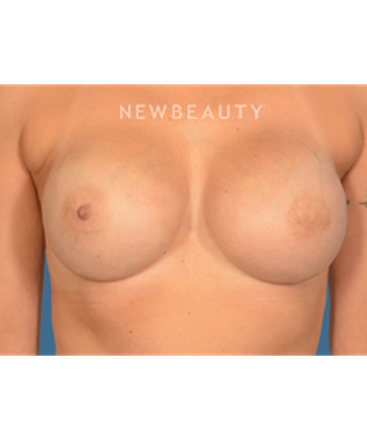 dr-bryan-gawley-breast-reconstruction-b