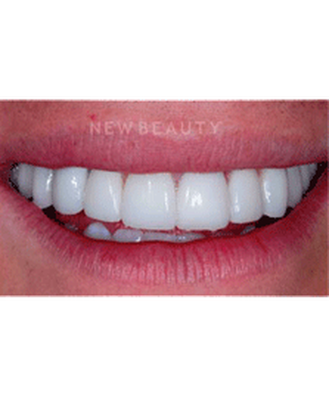 dr-guy-lewis-veneers-b