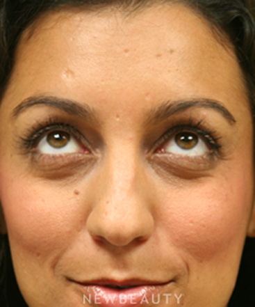 dr-jennifer-levine-botox-b