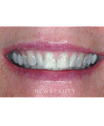 dr-guy-m-lewis-smile-makeover-b