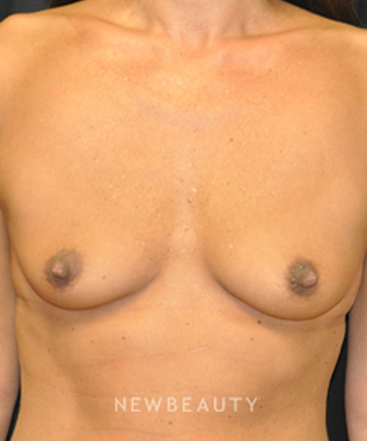 dr-andrew-smith-breast-augmentation-b
