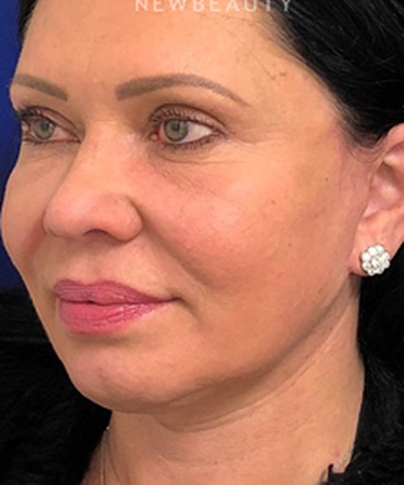dr-dilip-madnani-facelift-necklift-b