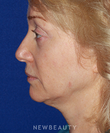 dr-konstantin-vasyukevich-facelift-b