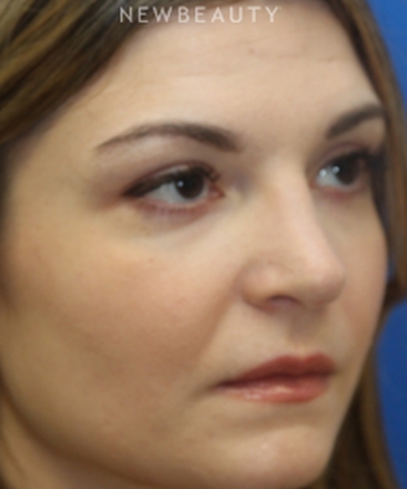 dr-jennifer-m-levine-revision-rhinoplasty-b