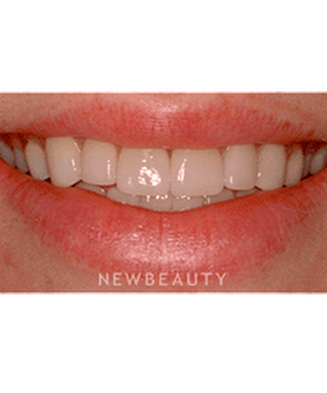 dr-laurence-rifkin-veneers-b