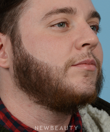 dr-jeffrey-b-wise-hair-transplant-b