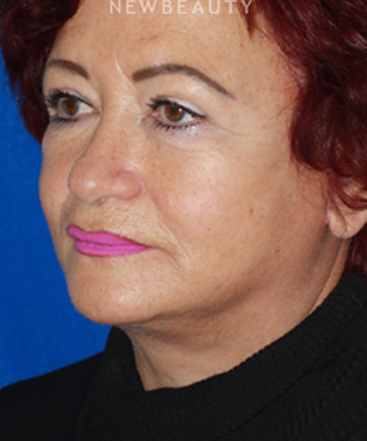 dr-konstantin-vasyukevich-lower-facelift-b